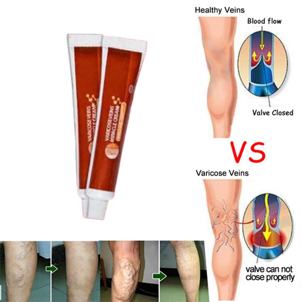 Treatment For Phlebitis In The Leg Thrombophlebitis Diagnosis And