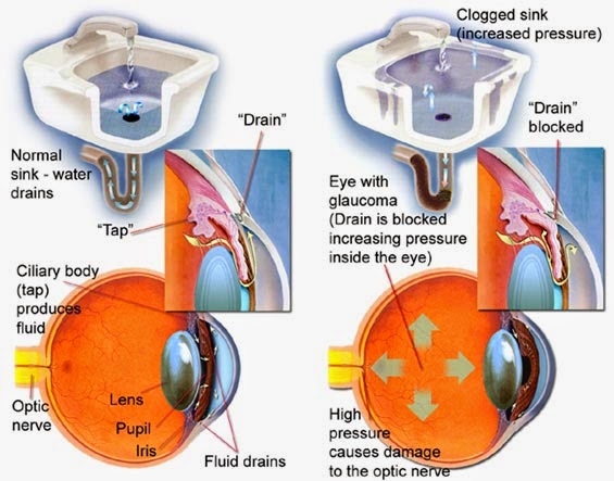 Глаукома латынь. Терминальная глаукома. Неопластическая глаукома. Кистозная фильтрационная подушка глаукома. Эпидемиология глаукомы.