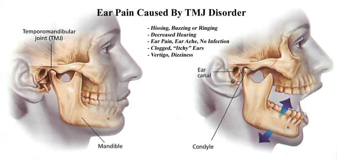 Болит челюсть при открытии возле уха. Болит челюсть возле уха и ухо. Лимфоузел височно нижнечелюстного сустава.