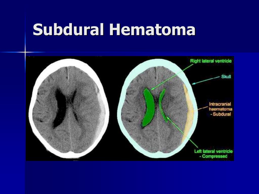 Сдавление головного мозга гематомой