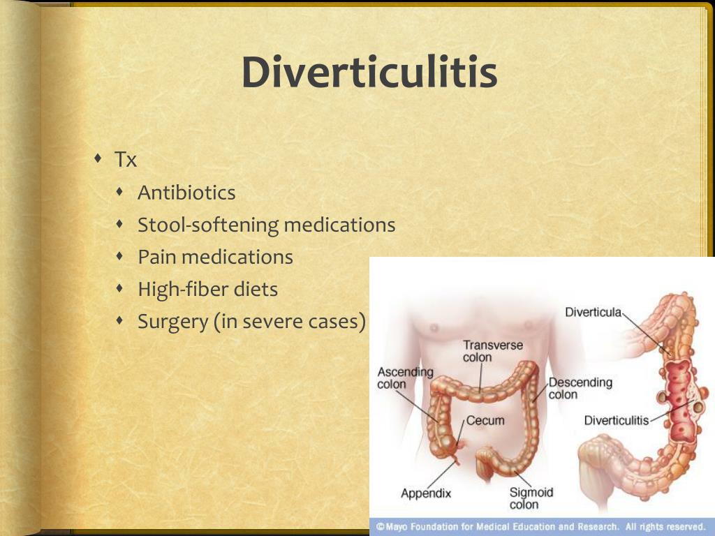 Diverticulitis tratamiento