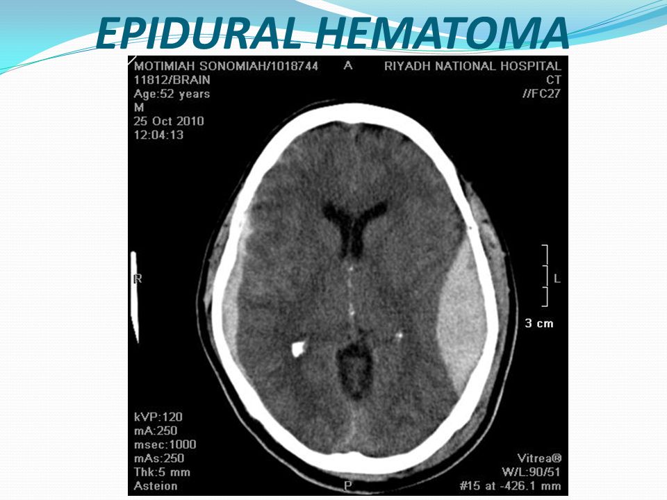 Hominick Hematoma