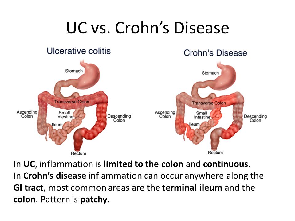 Colitis Versus Diverticulitis Diverticulitis Vs Ulcerative Colitis A 