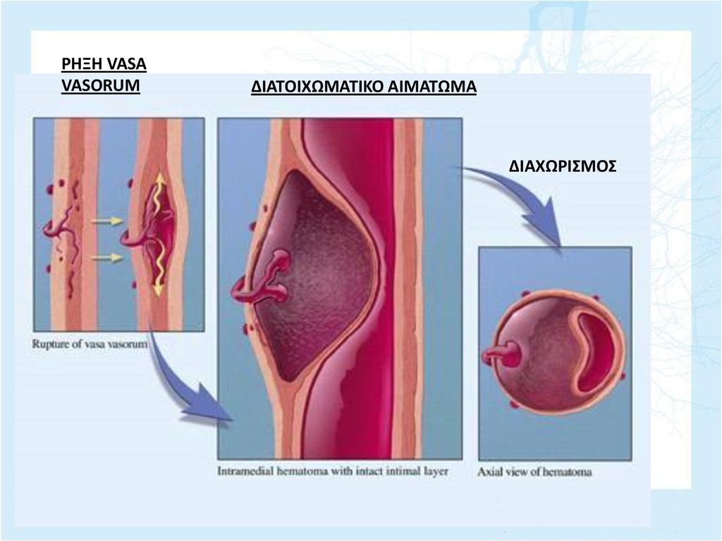 Hominick Hematoma