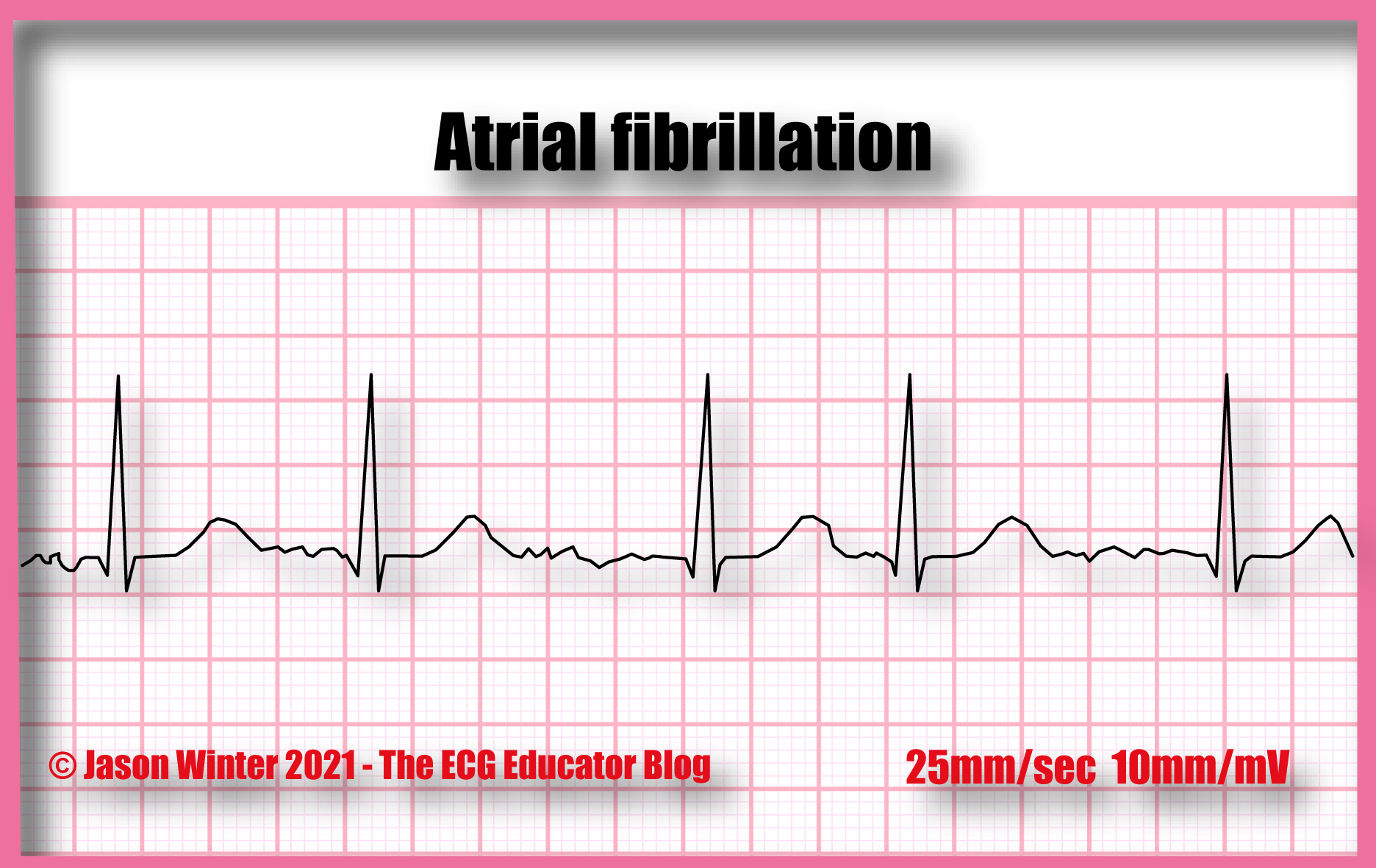 afib-ekg-rhythm-strip-sexiz-pix