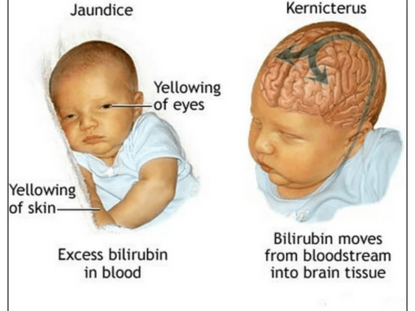 Билирубин при желтухе у новорожденных