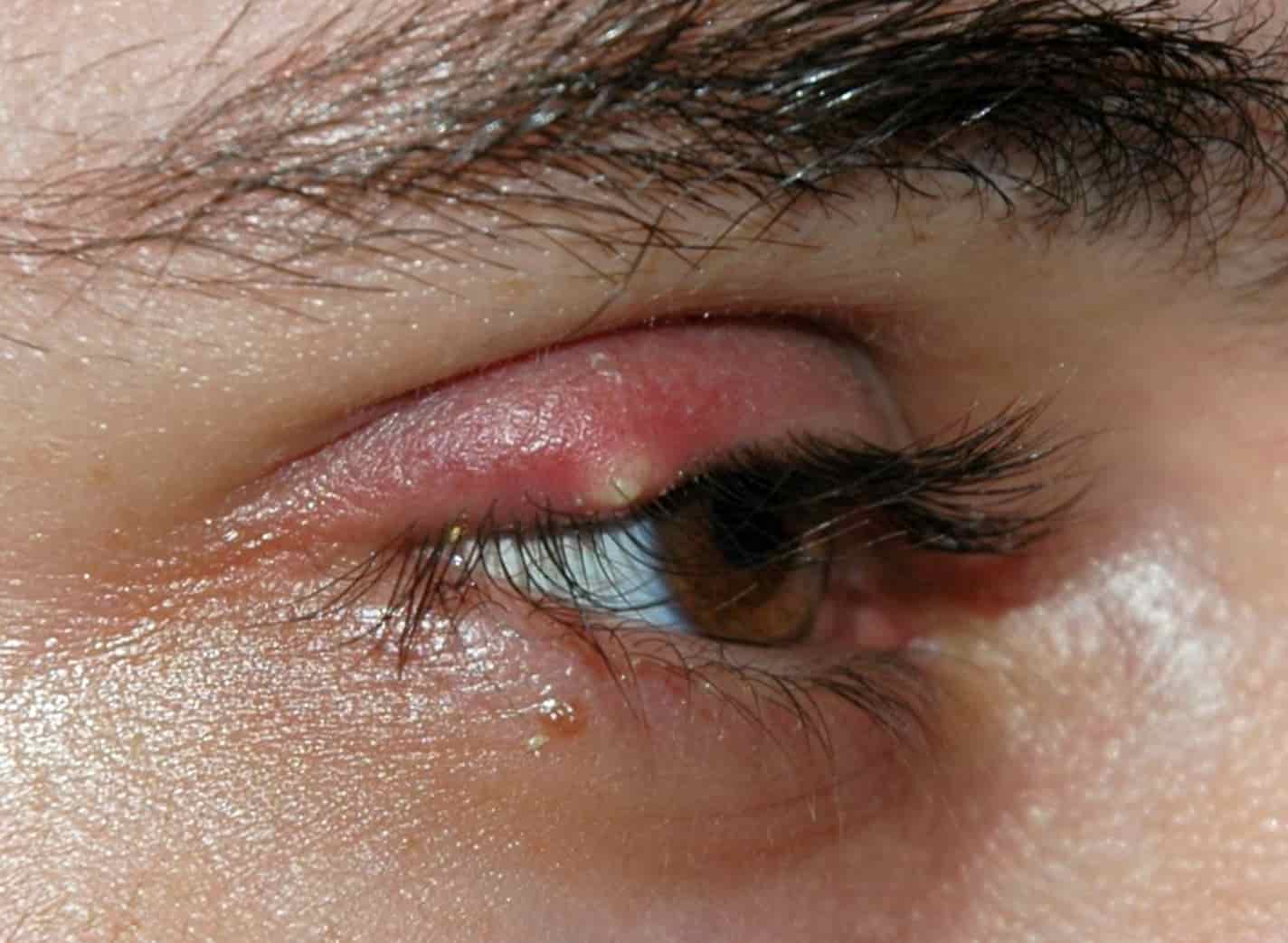 How long does a chalazion last Chalazion Information Mount Sinai