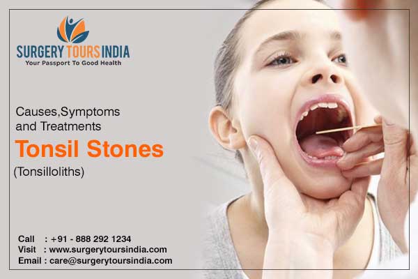 Surgery For Tonsil Stones Causes Symptoms Removal Treatment