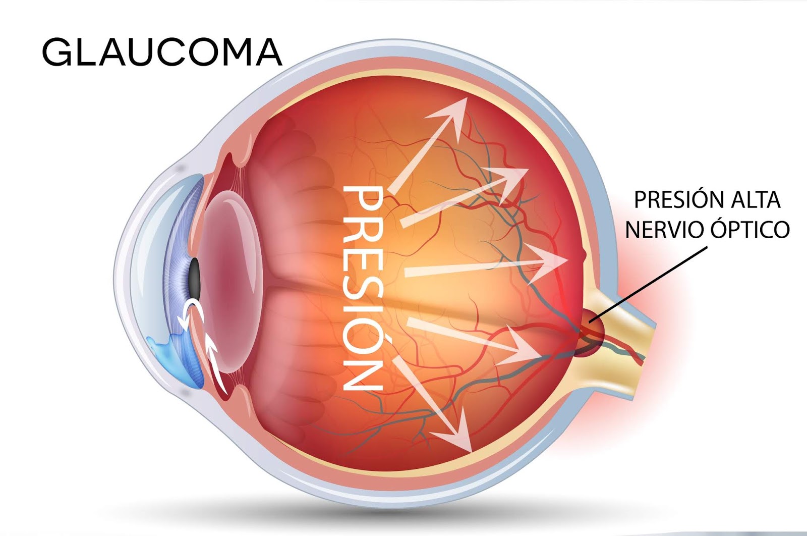 Глаукома латынь. Глаукома причины возникновения. Посттравматическая глаукома.