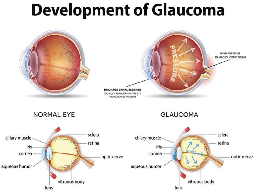 Глаукома латынь. Заболевание глаз глаукома. Глаукома схема.