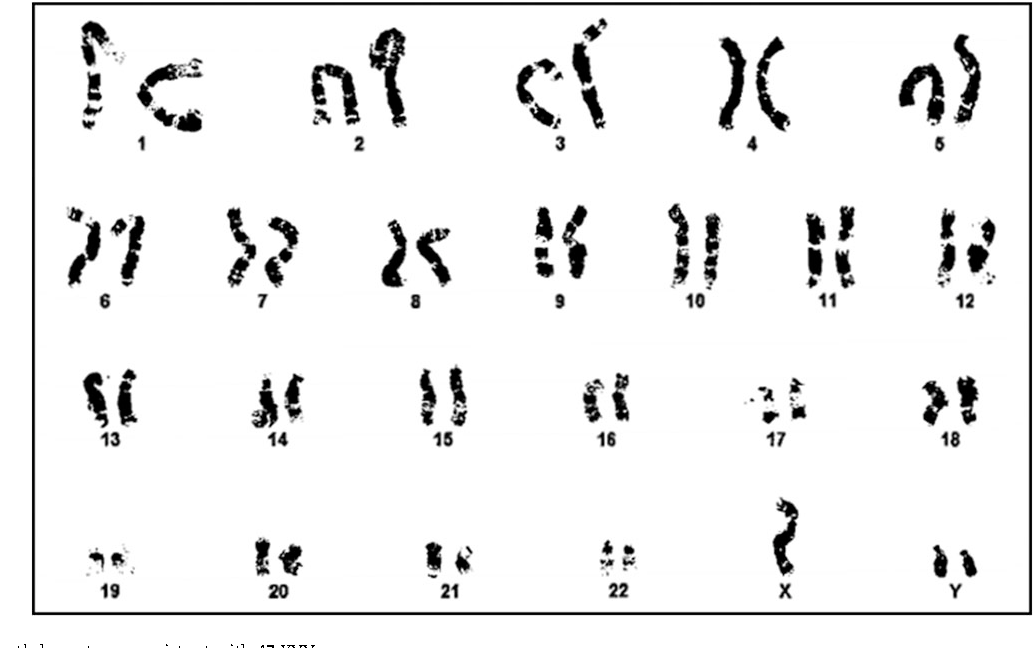 Пересадка хромосом. 47 XYY кариотип. XYY кариограмма. Синдром Джейкобса кариотип. XYY хромосомы 47.