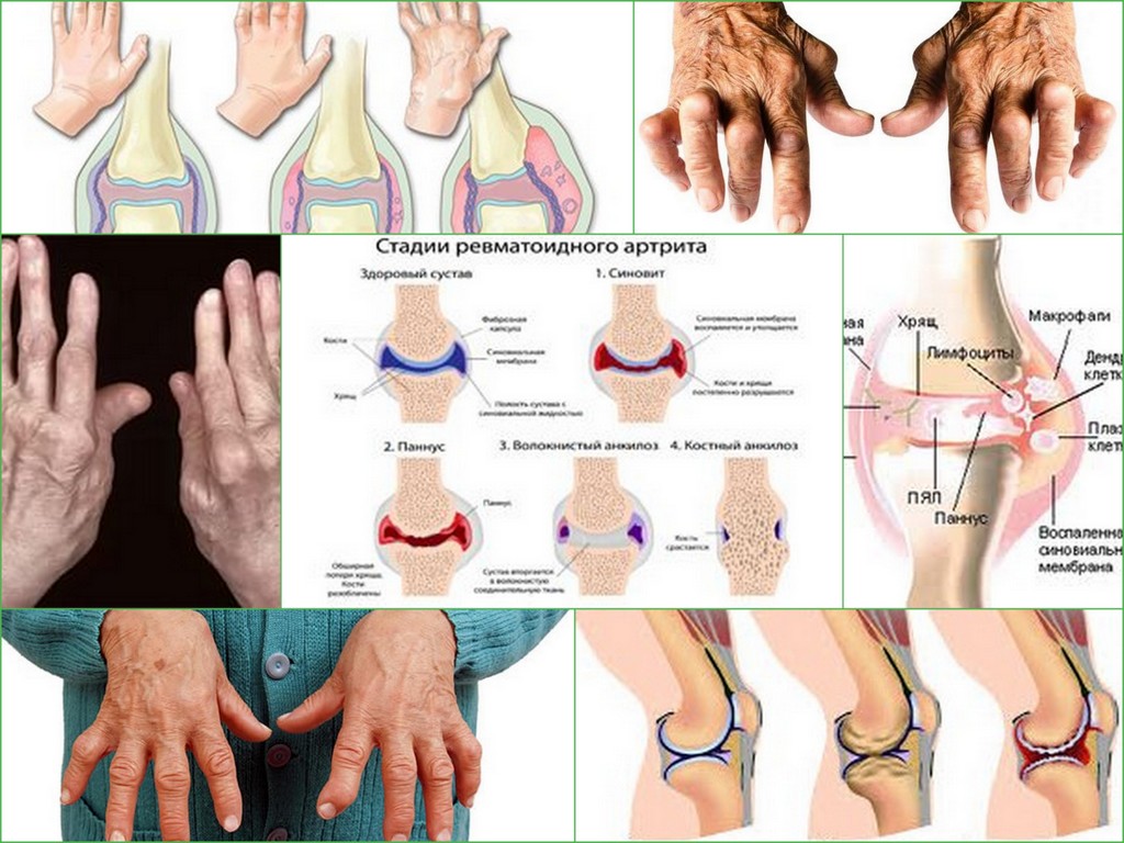 Ревматическое поражение суставов. Схема поражения суставов при ревматоидном артрите. Ревматоидный артрит диагностика стадии. Стадия 2 ревматоидного артрита кистей. Клинические формы ревматоидного артрита.