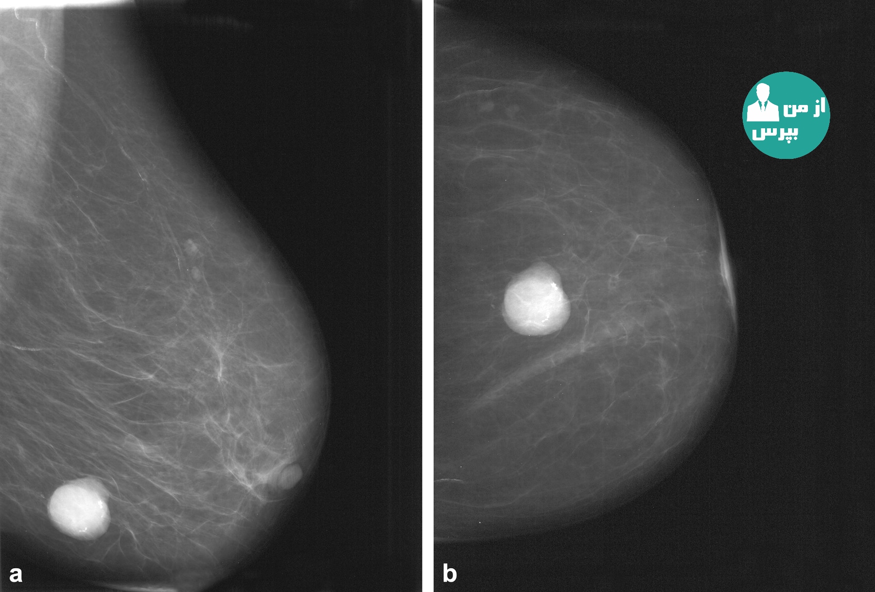 Маммография молочных желез 4. Киста молочной железы маммограмма. Фиброзная мастопатия маммограмма. Фиброзная мастопатия на маммографии. Инволютивная фиброаденома.
