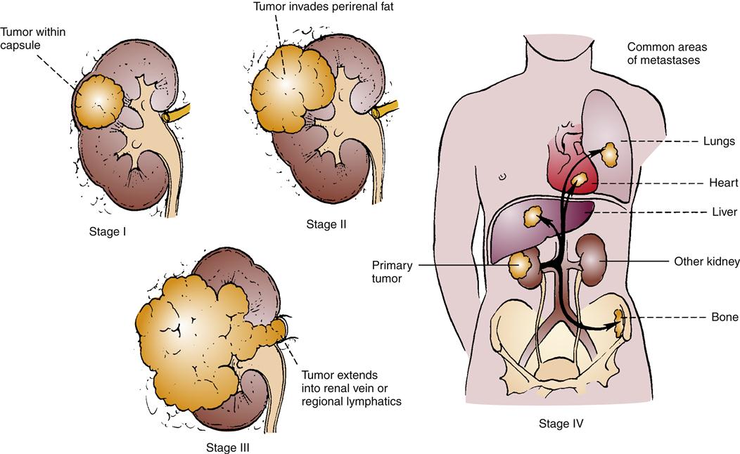 Gutartiger tumor niere symptome