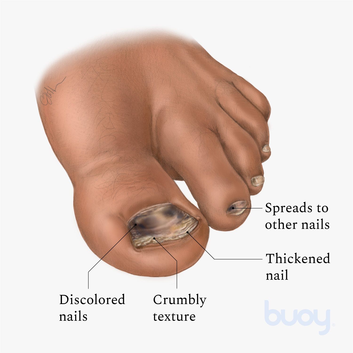 Toenail white spots treatment White Toenails & White Spots on Toenails