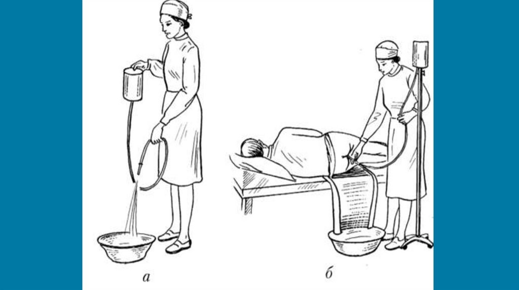 Кишечные клизмы. Сифонная клизма алгоритм. Сифонная клизма оснащение. Очистительная клизма сифонная клизма,гипертоническая клизма. Очистительная клизма Кружка Эсмарха алгоритм.