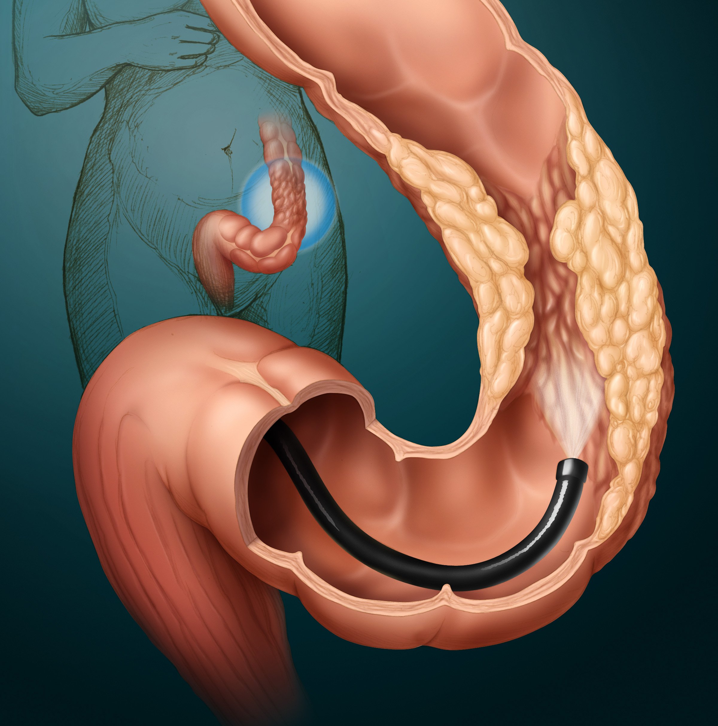 Процедура эндоскопия кишечника