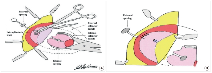 Internal open. Lift (ligation of intersphincteric Fistula tract). Процедура Lift (ligation of intersphincteric Fistula tract) техника. Коронарно-легочная фистула.