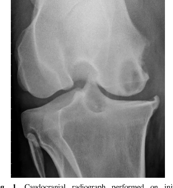 Subchondral Degenerative Cysts Subchondral Bone Cyst Symptoms Causes And Treatments 2659