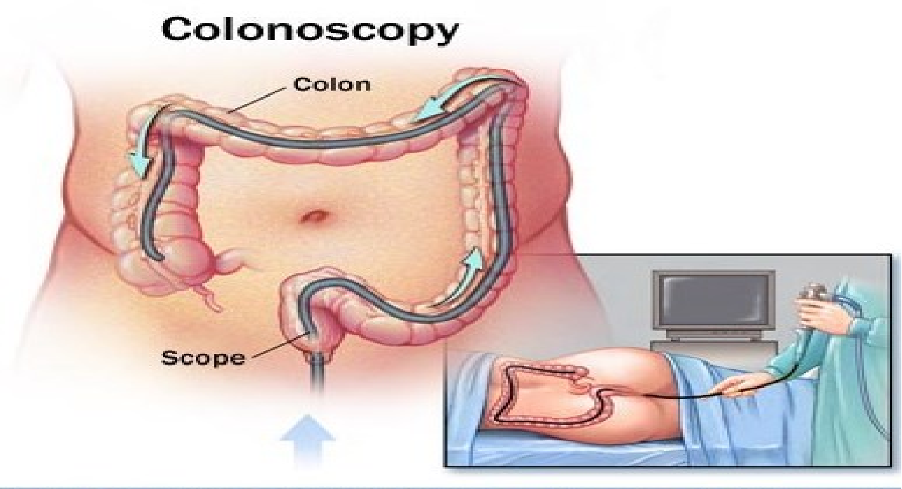 Длина колоноскопии. Синдром раздраженного кишечника колоноскопия. Колоноскопия прямой кишки. Скрининговая колоноскопия.