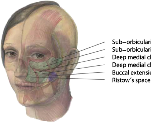 Пространство лица. Пространство Ристоу лицо. Пространство Ристоу лицо анатомия. Sub orbicularis Oculi fat. Пространство Ристоу топография.