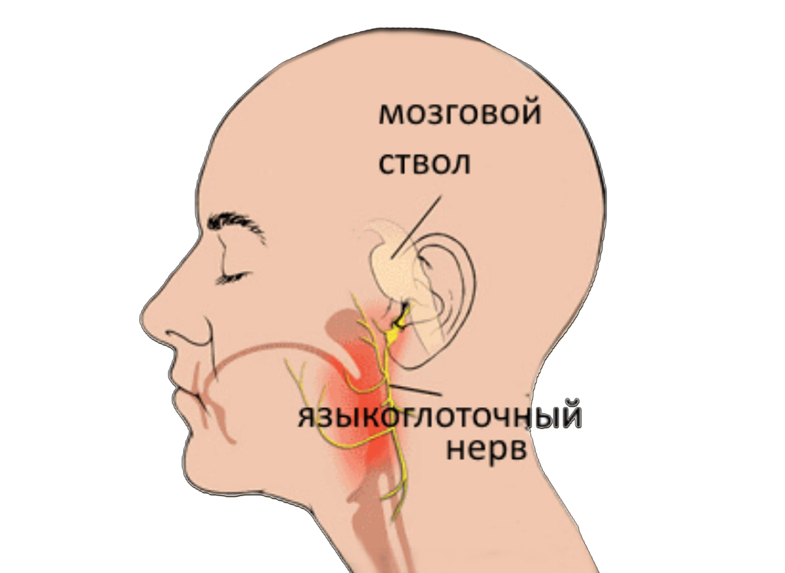 Воспаление нерва уха симптомы. Языкоглоточный нерв. Невралгия языкоглоточного нерва. Языкоглоточный нервы. Поражение языкоглоточного нерва.