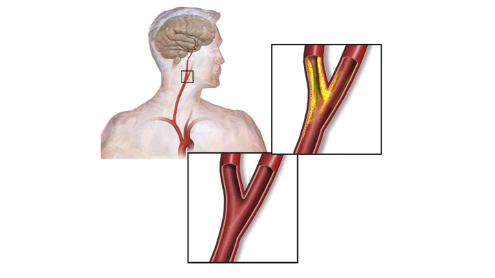 Стеноз внутренней сонной артерии операция. Брахиоцефальные артерии атеросклероз. Атеросклероз сосудов сонных артерий. Бляшка на шее операция