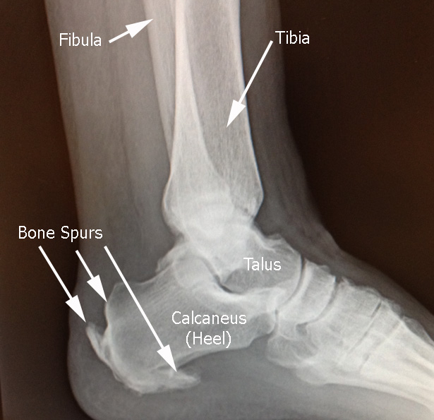A bone spur might be treated with Bone Spur Causes, Treatment
