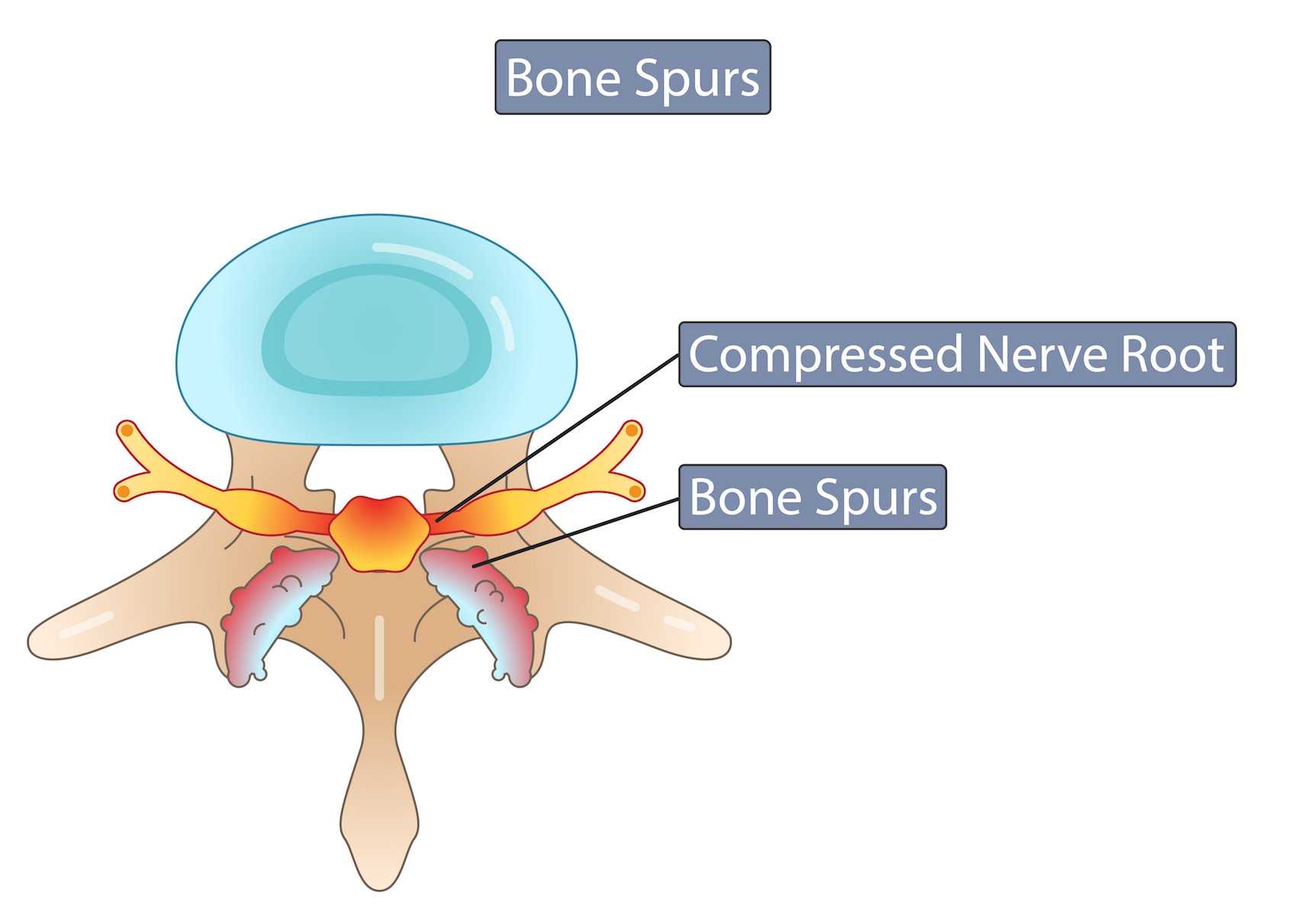 Define Bone Spur Bone Spurs Symptoms And Causes 7430