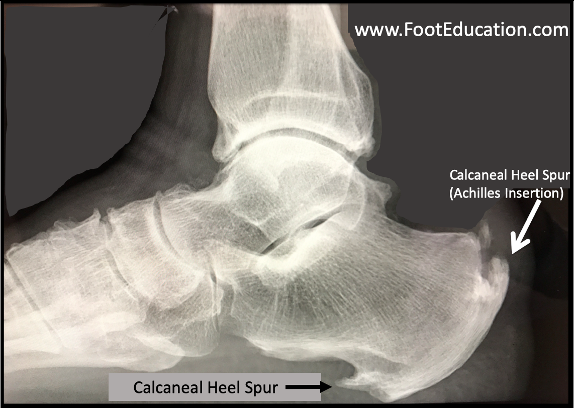 Bone spur in heel and achilles tendon: The 2 Common Types of Heel Spurs