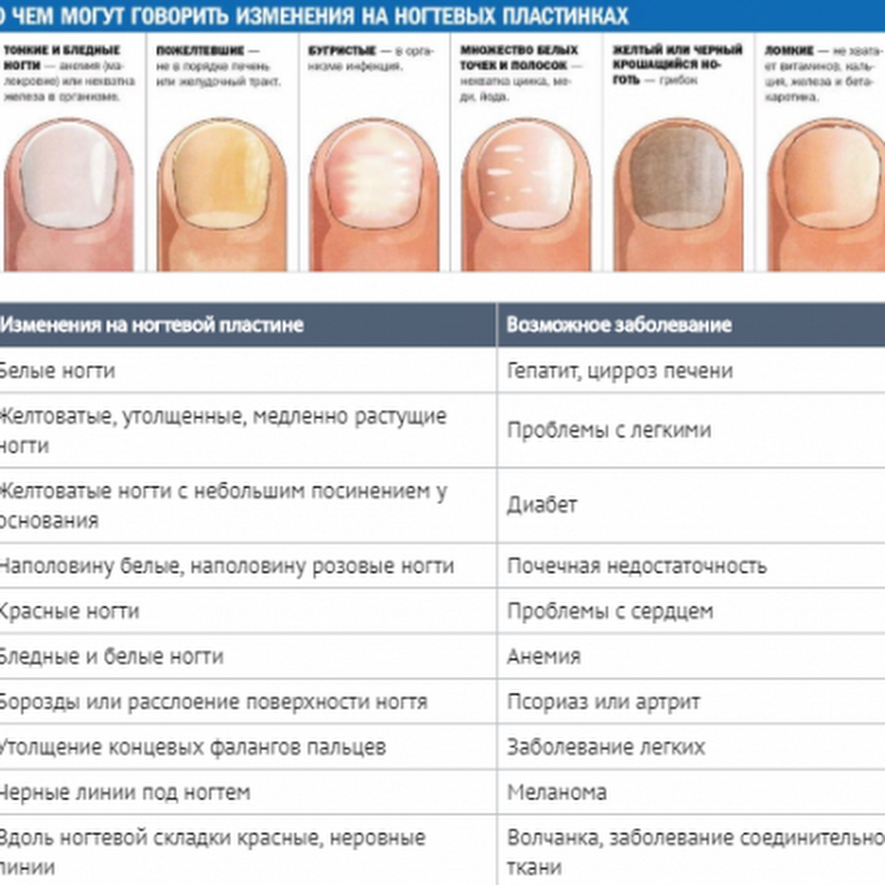 По ногтям определить человеком. Определение болезни по состоянию ногтей. Заболевания ногтей на руках таблица описание. Как определить по цвету ногтей заболевание. Выявление болезни по ногтям.
