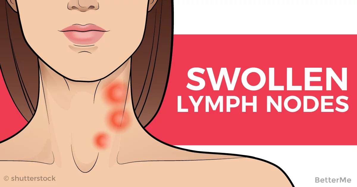 swollen tender supraclavicular lymph nodes