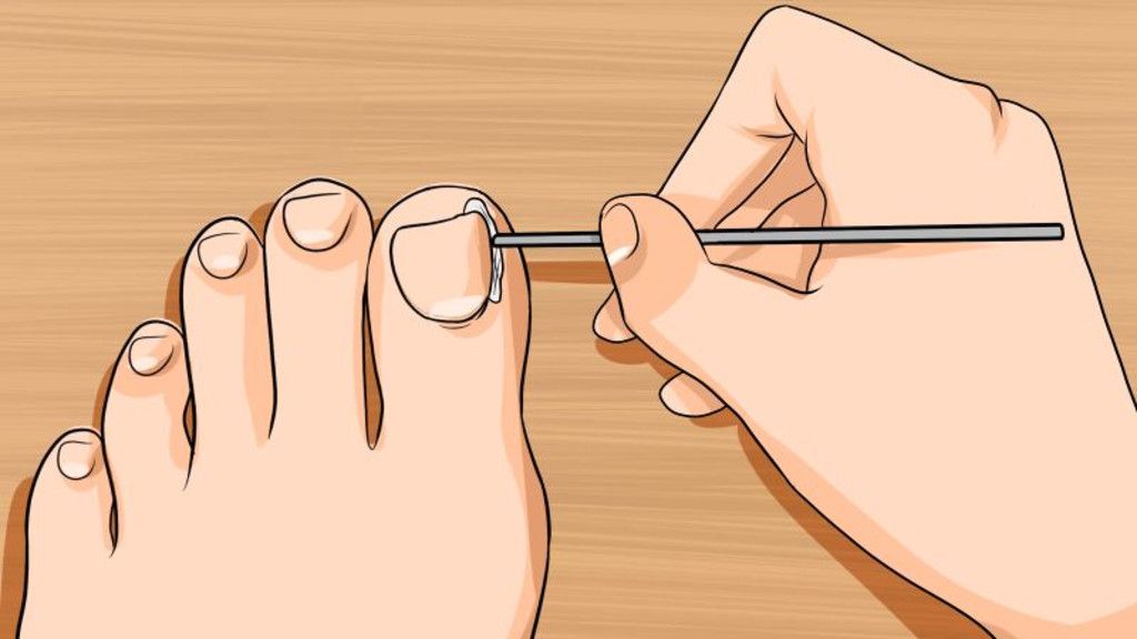 Как подстригать ногти на большом пальце. Правильная стрижка ногтей на ногах. Правильное подстригание ногтей на ногах. Как правильно подстригать ногти на ногах.
