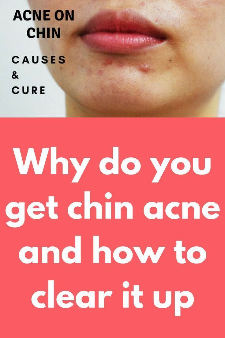 Why do i get acne on my back: Acne Types and Symptoms