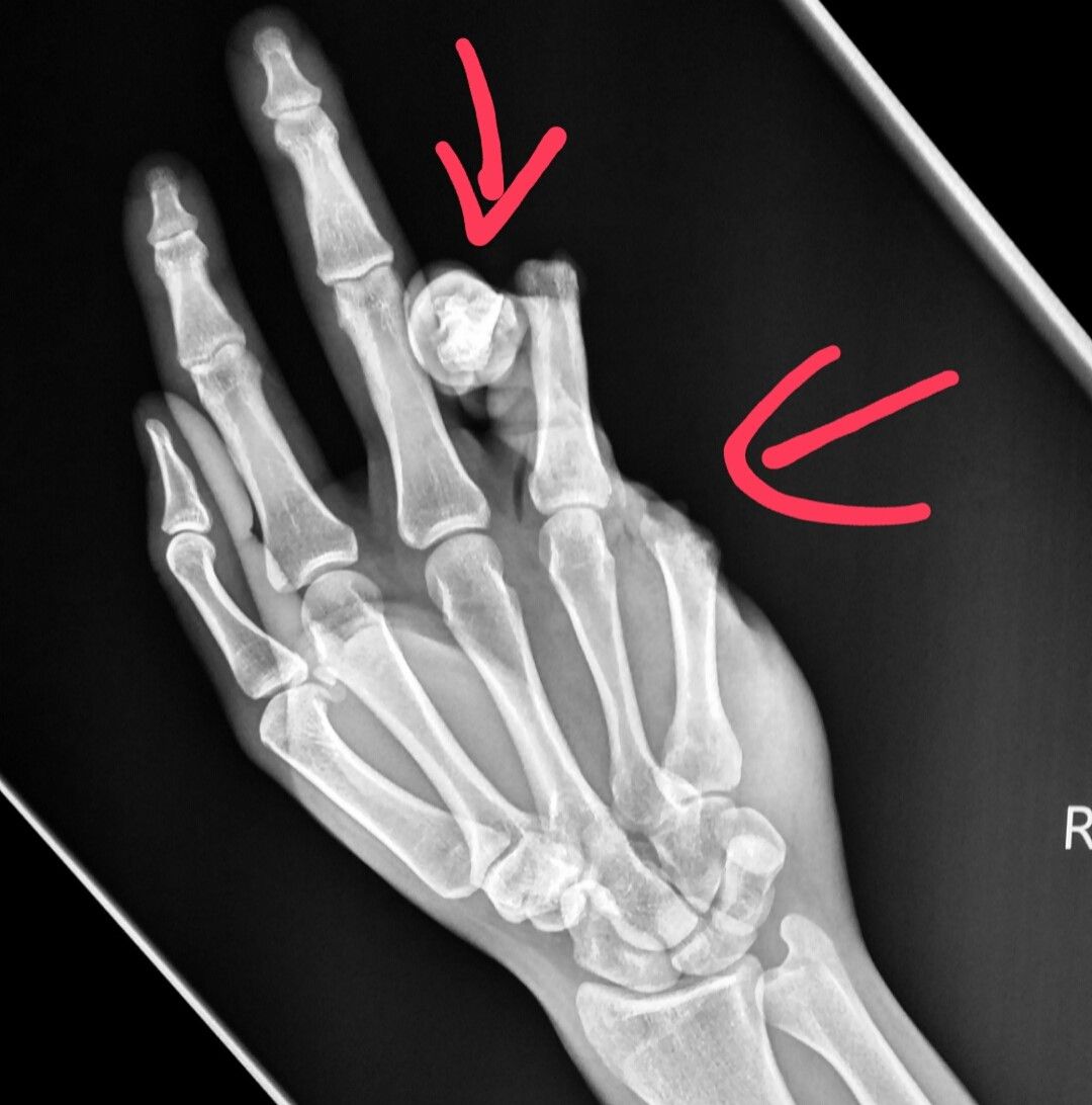 X Ray Of Broken Pinky Finger Broken Finger Symptoms X Ray Tips 