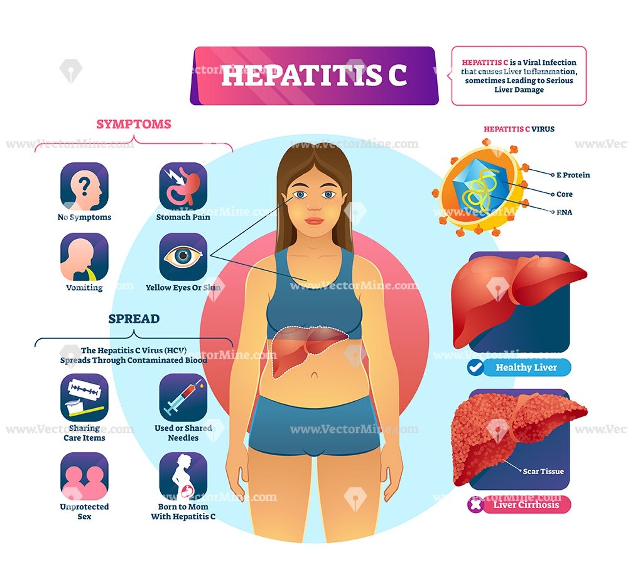 Hcv Signs And Symptoms Hepatitis C Diagnosis And Treatment 