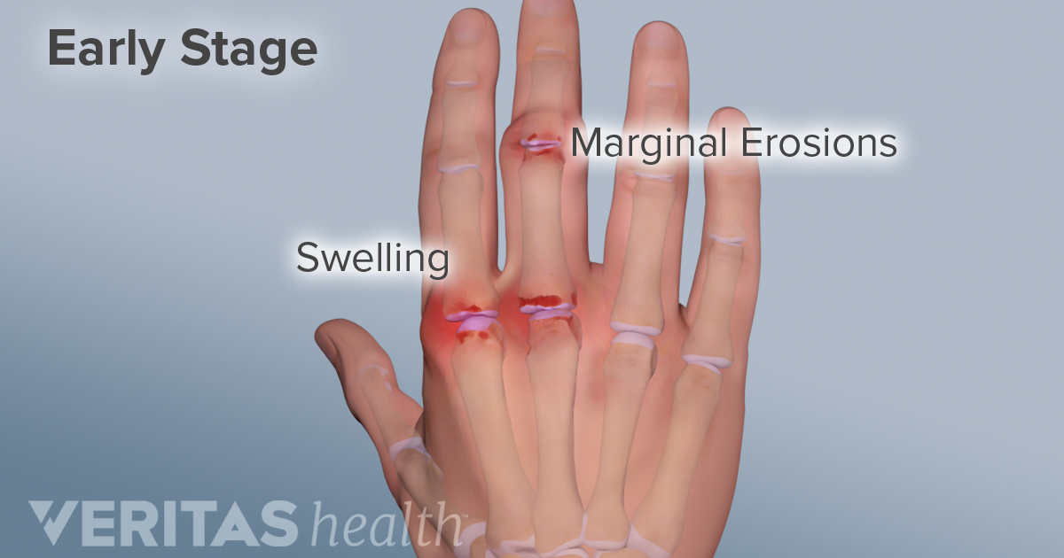 Why Are My Fingers Randomly Swelling