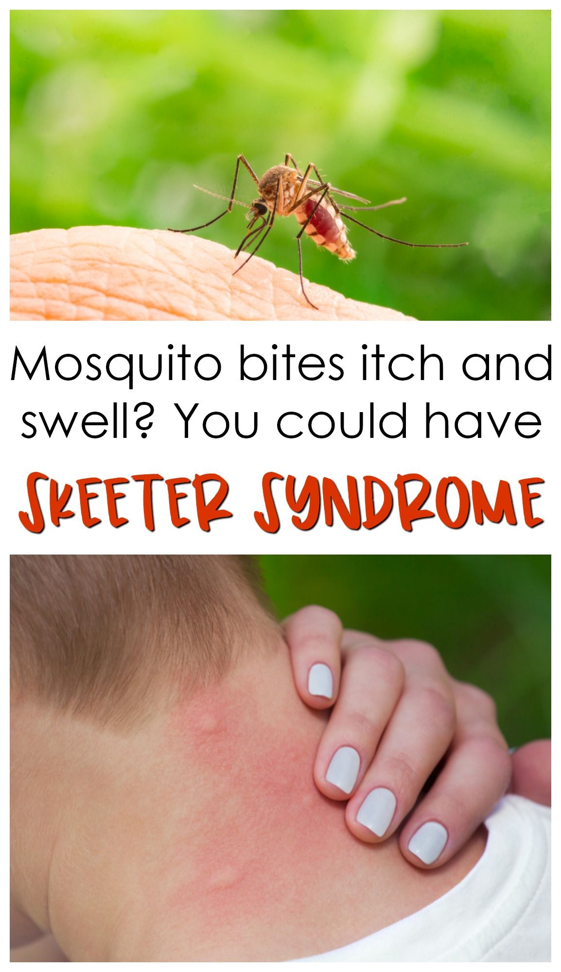 Mosquito bite like bumps on body: Itchy bumps on skin like mosquito ...