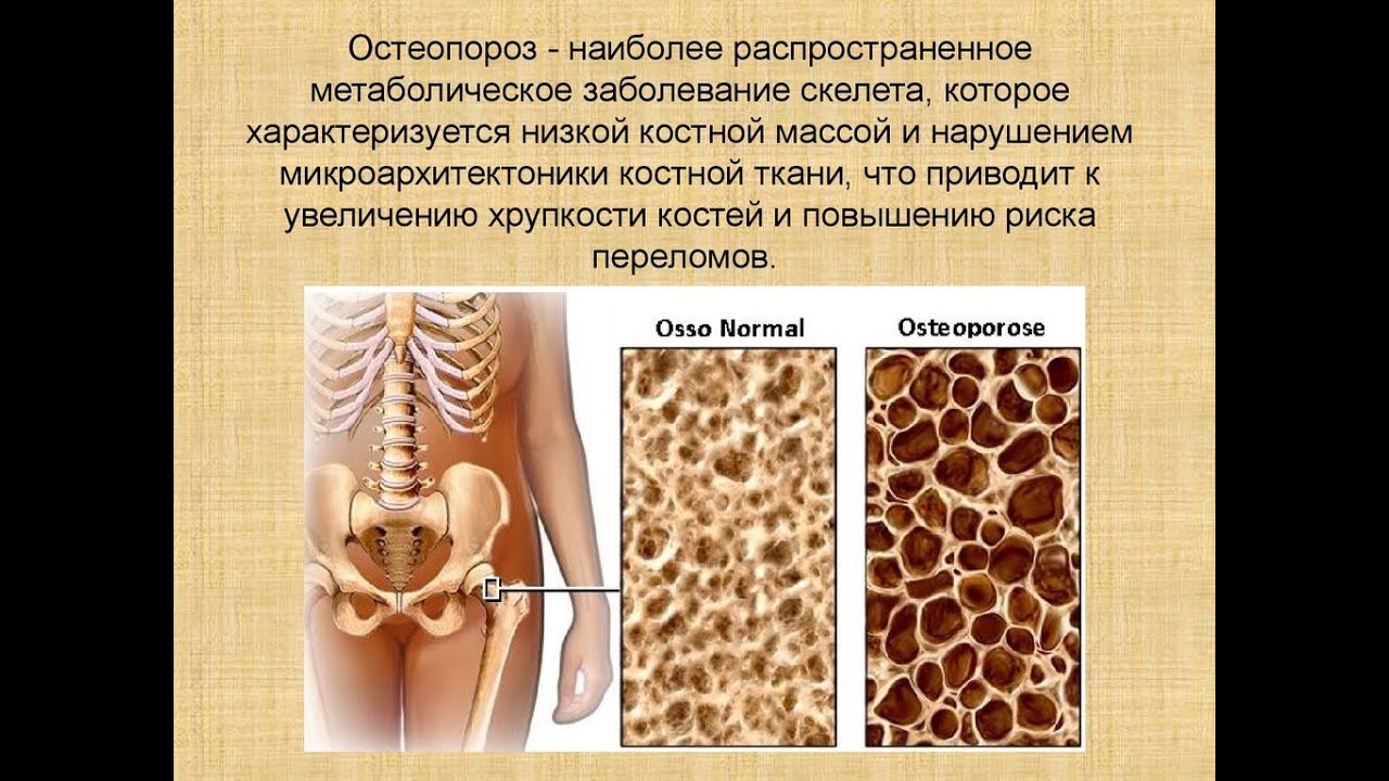 Ткань скелета человека. Остеопороз. Остеопороз кости. Остеопения и остеопороз. Нормальная кость и остеопороз.