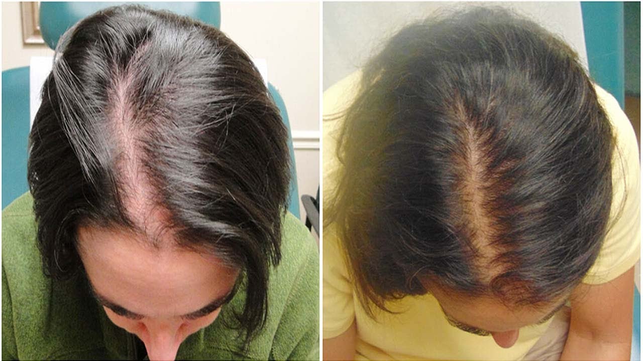 Выпадают волосы после покраски. Мезотерапия для волос. Мезотерапия для волос до и после женщины. Выпадение волос до и после.