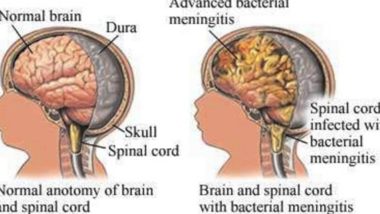 Воспаление мозга на латинском. Менингит энцефалит и менингоэнцефалит. Менингоэнцефалит, воспаление головного мозга. Менингит мозговой бактериальный. Бактериальный менингоэнцефалит головного мозга у детей.