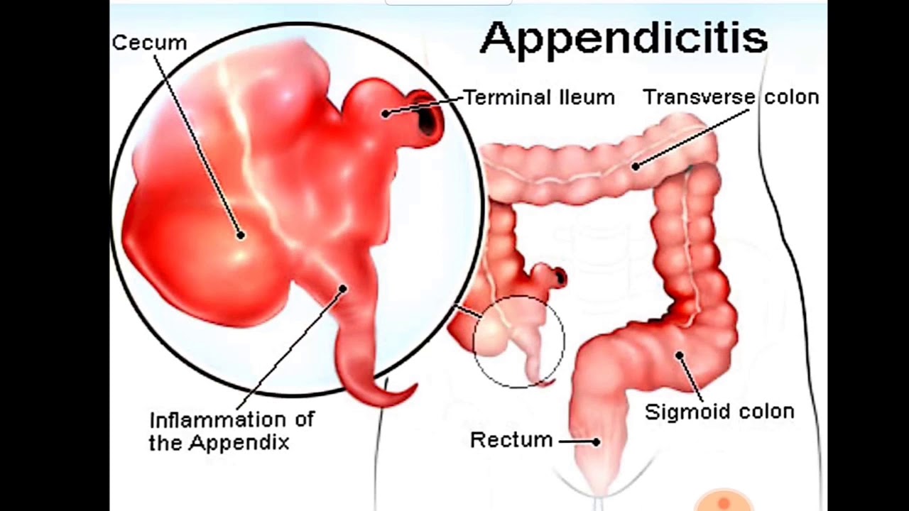 Аппендикс и аппендицит. Фотография аппендицита.