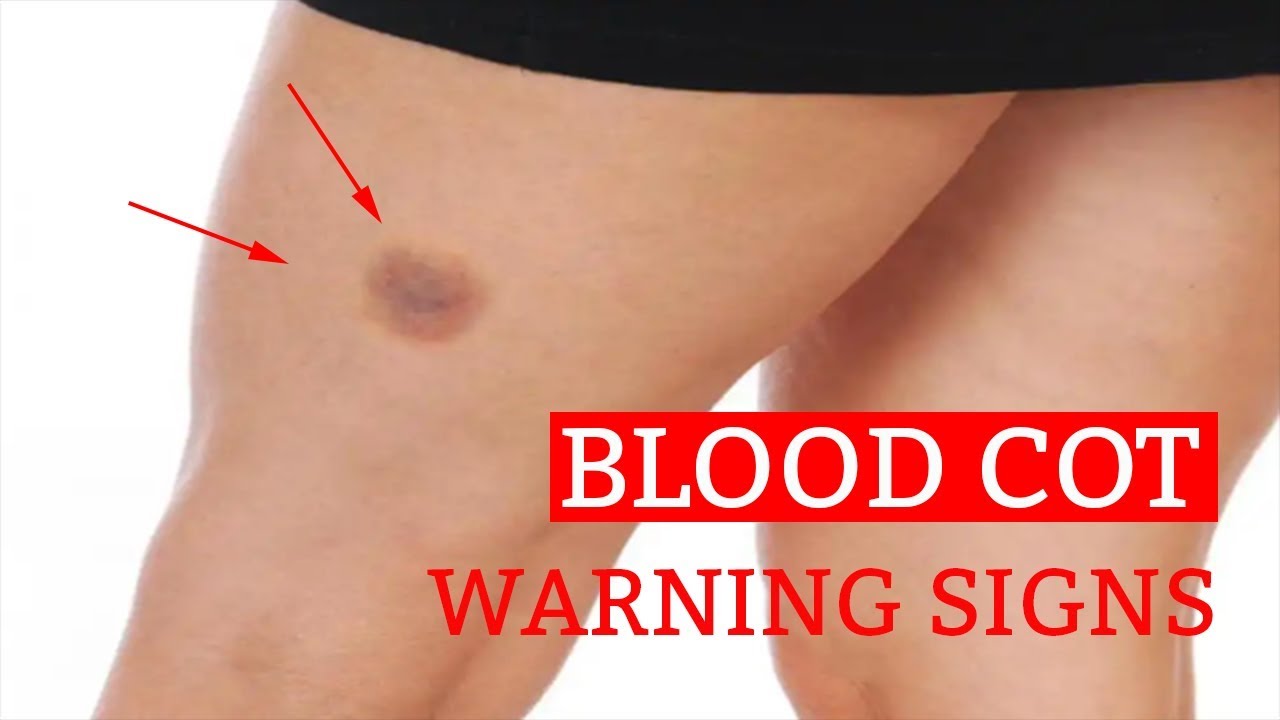 sign of a blood clot in your leg