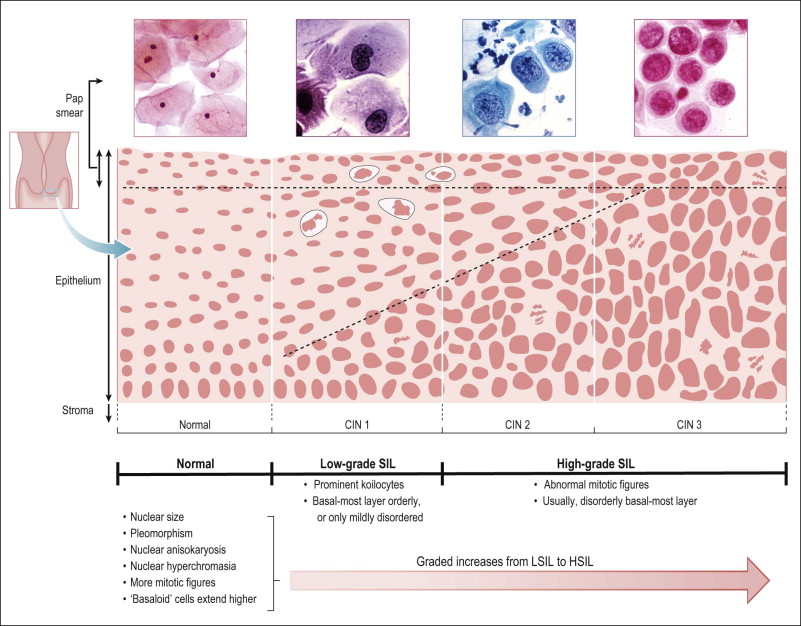 high-grade-lesion-in-cervix-high-grade-squamous-intraepithelial-lesion