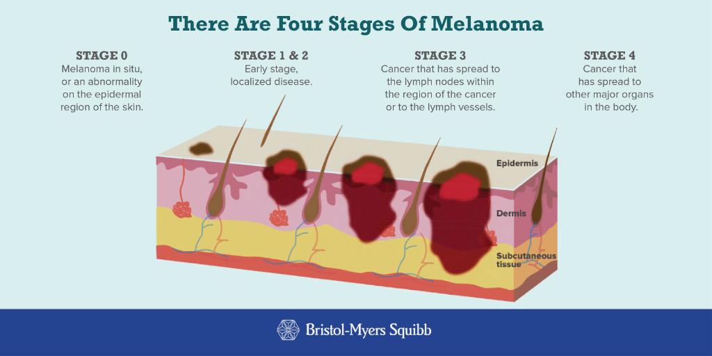 What Is Metastatic Melanoma Metastatic Melanoma Causes Symptoms And