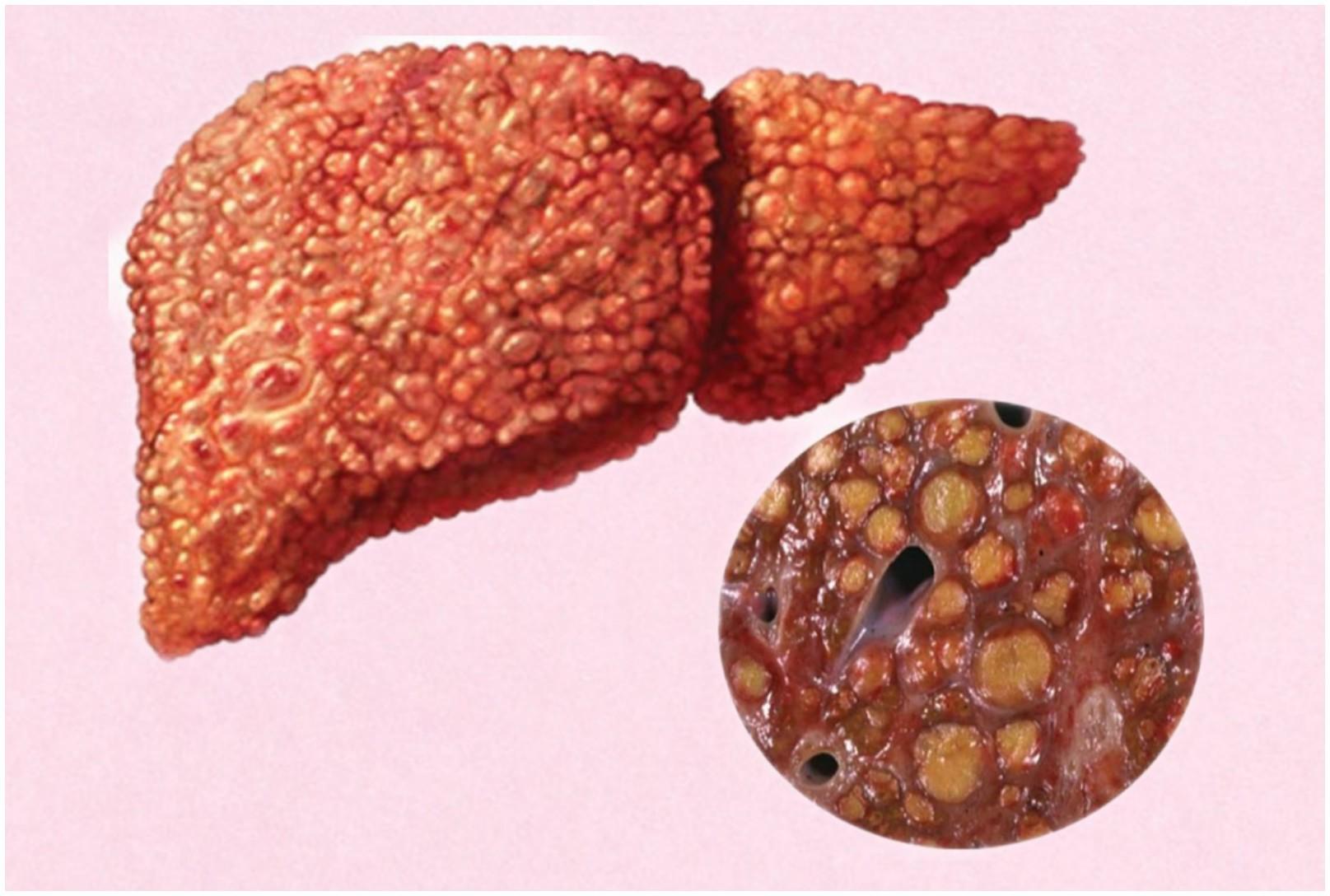 Гепатит ру. Токсический гепатит макропрепарат. Жировой гепатоз печени макро. Гепатит печени макропрепарат. Жировой гепатоз макропрепарат.