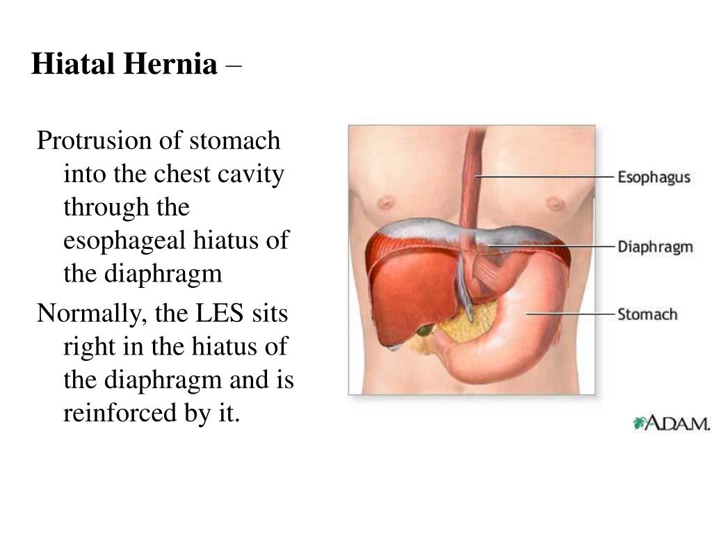 Hernia de hiato inflamada