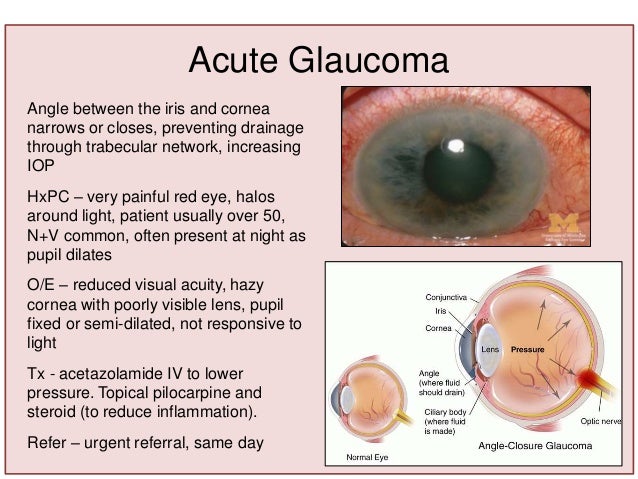 Глаукома латынь. Посттравматическая глаукома.