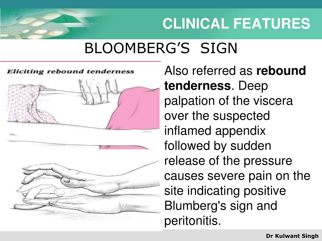 appendicitis-rebound-pain-appendicitis-symptoms-and-warning-signs