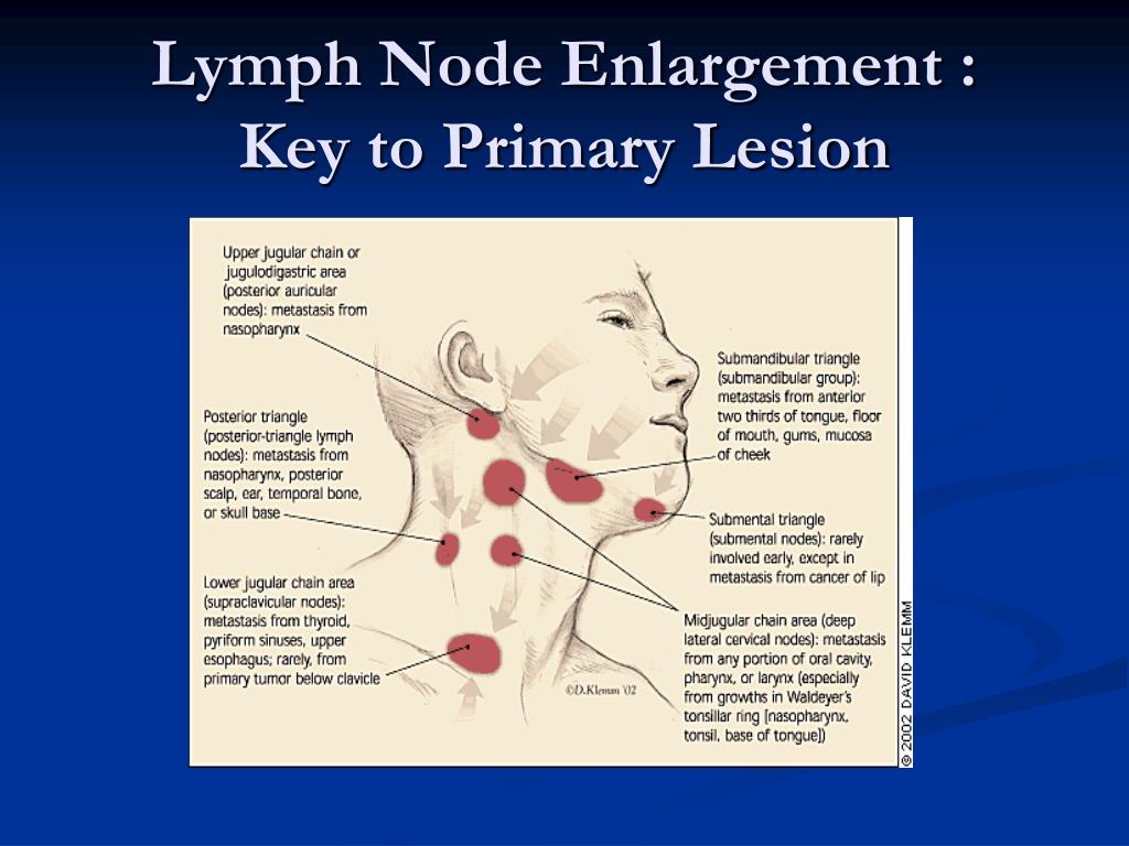 hpv weight loss swollen supraclavicular lymph node